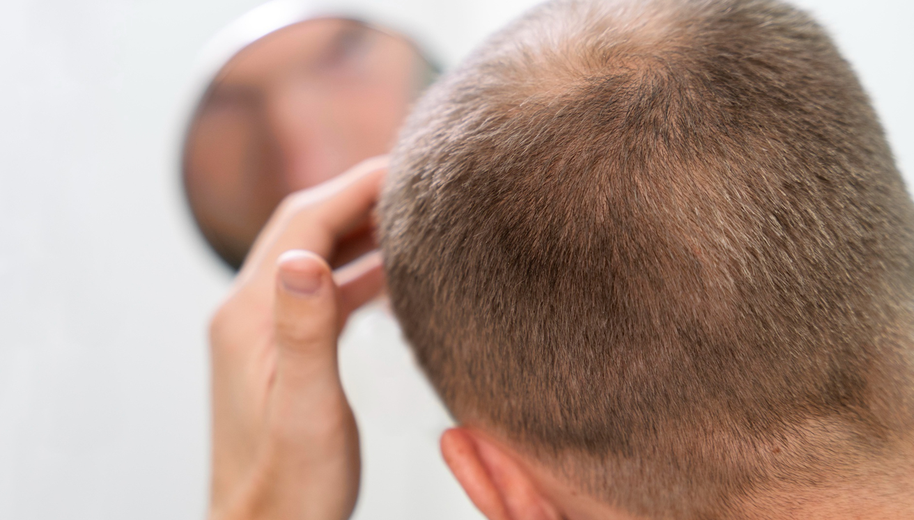 Is PP405 Hair the Real Cure for Baldness? Experts Say It Might Be