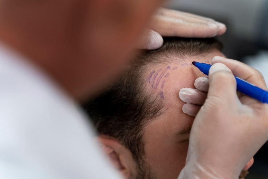 How Much Is Hair Transplant Surgery? You Might Be Shocked by the Real Numbers